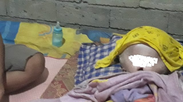 Bayi Pengidap Hydrocephalus di Sausu Tambu Parimo Butuh Bantuan